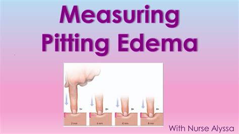 shin compression pitting edema test|how to measure pitting edema.